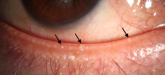 mgd患者的下眼睑,可见睑缘油脂性的栓子(箭头)堵塞圆形的腺体开口