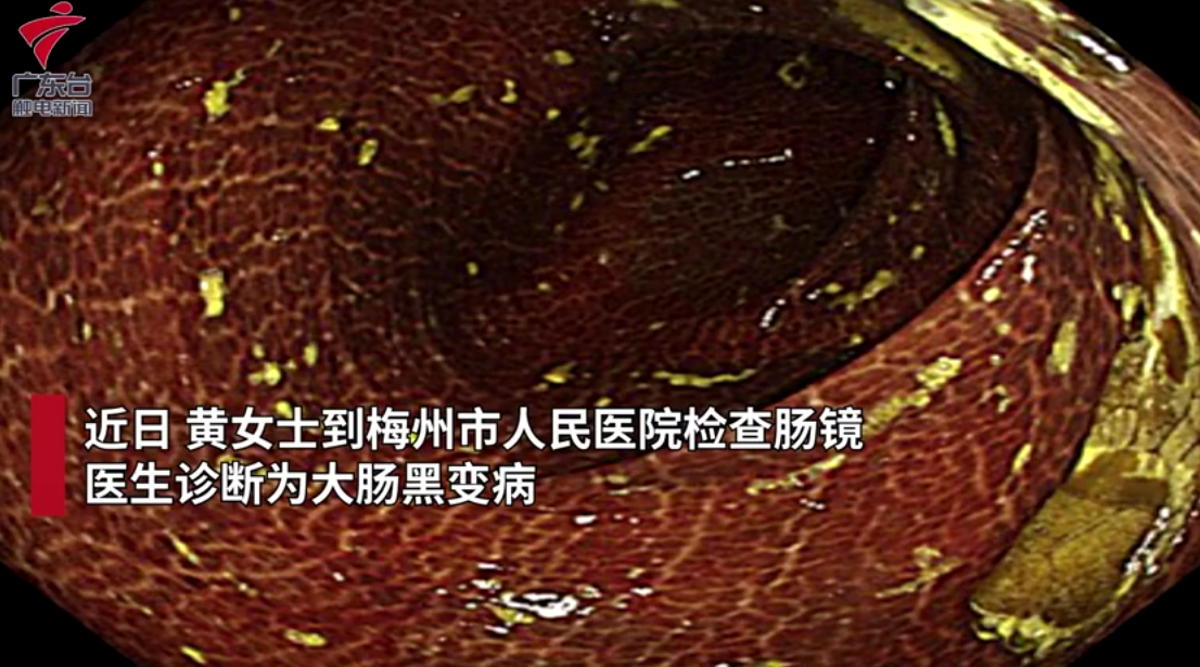 近日,黄女士到梅州市人民医院检查肠镜,被确诊为结肠黑变病